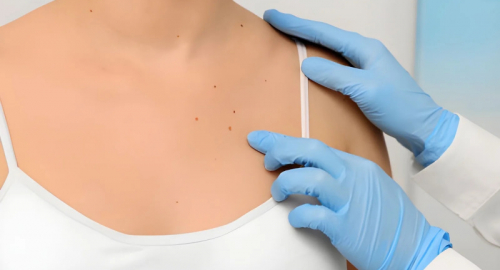 Morbillo in Italia, 472 casi nel 2026: chi rischia e cosa cambia